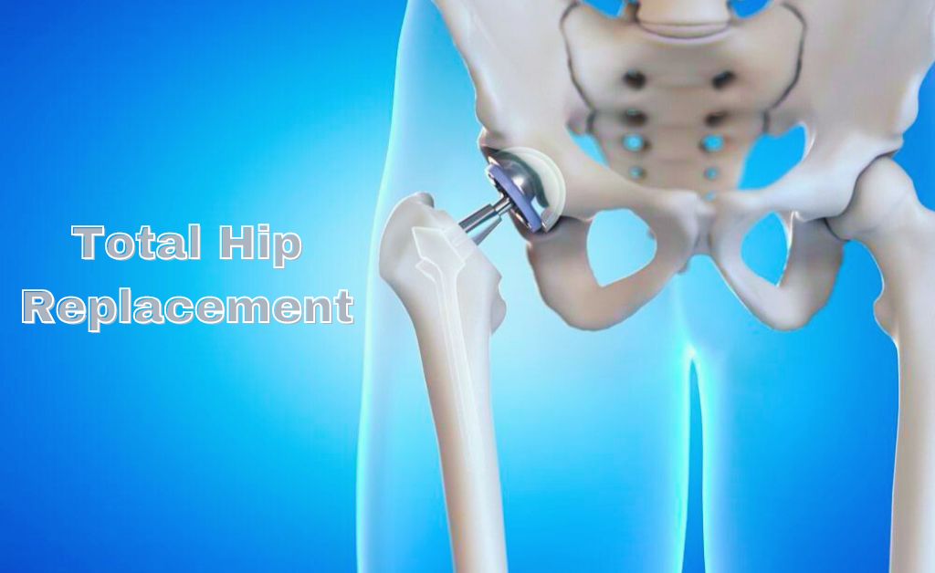 Total Hip Replacement – Comprehensive Guide to Surgery, Causes, and Recovery